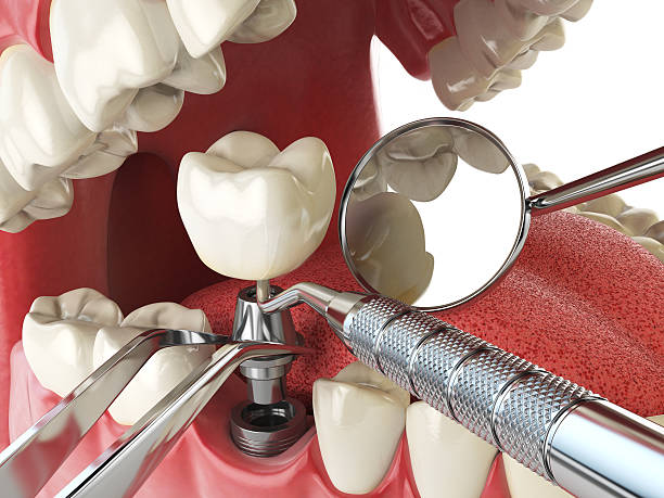 Best Emergency Dental Extractions in Los Alamos, CA